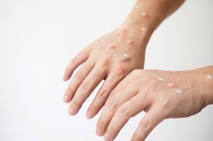 Hasil Labor Kemenkes, 2 Warga Kepulauan Meranti Negatif Virus Cacar Monyet
